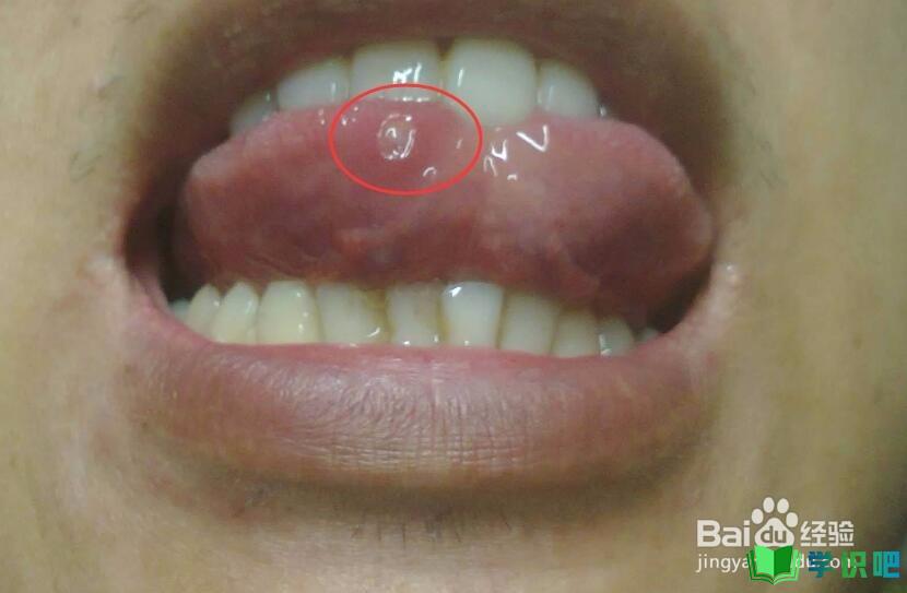 舌头溃疡怎么治最好？ 第4张