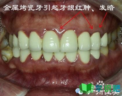 牙龈发综色如何恢复正常？ 第4张