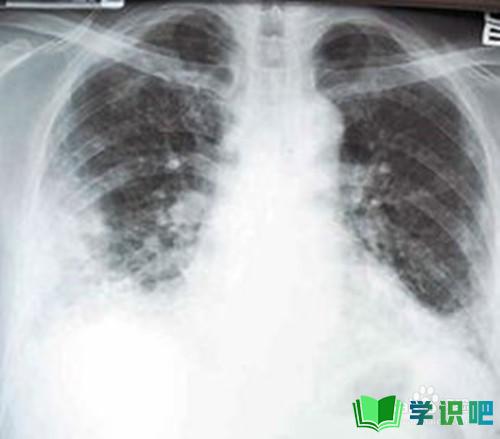 如何防止肺纤维化误诊？ 第6张
