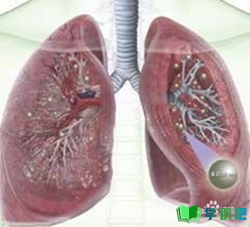 如何防止肺纤维化误诊？ 第7张