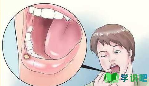 口腔溃疡怎么可以好得快？