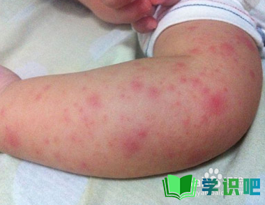 湿疹是怎么引起来的？ 第1张