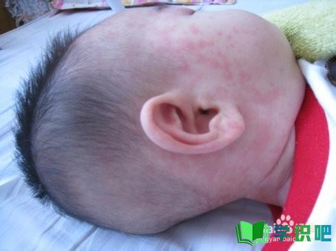 宝宝患了幼儿急疹怎么办？ 第8张