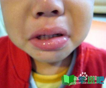 儿童嘴里有溃疡怎么办？