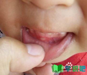 儿童嘴里有溃疡怎么办？ 第3张