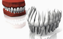 牙缝里有牙结石了怎么办？ 第6张