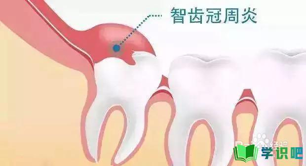 哺乳期长智齿牙龈肿痛怎么办？ 第1张