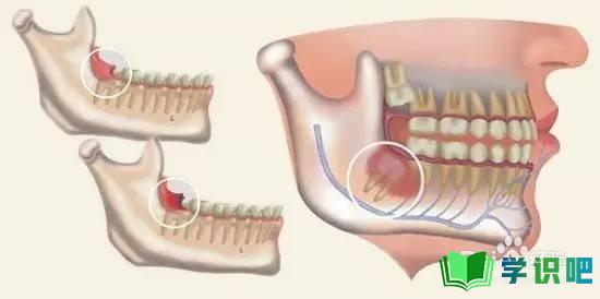 哺乳期长智齿牙龈肿痛怎么办？ 第2张