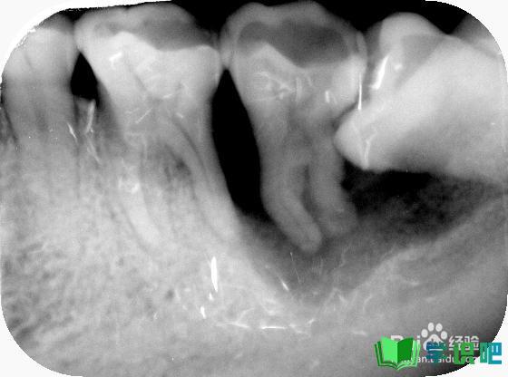 哺乳期长智齿牙龈肿痛怎么办？ 第5张