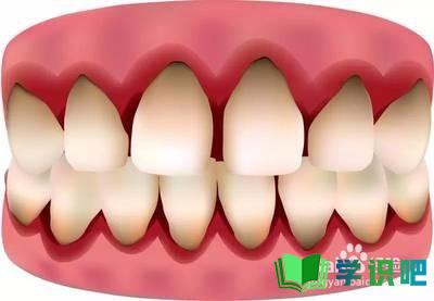 牙龈经常出血怎么办？ 第4张