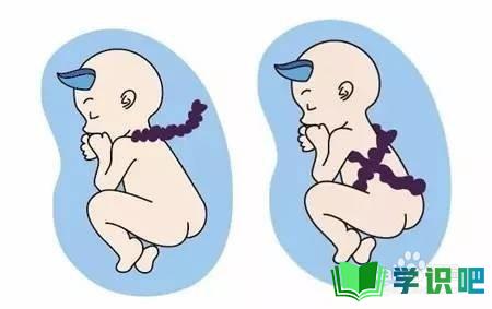 孕后期胎位不正脐带绕颈怎么办？ 第4张