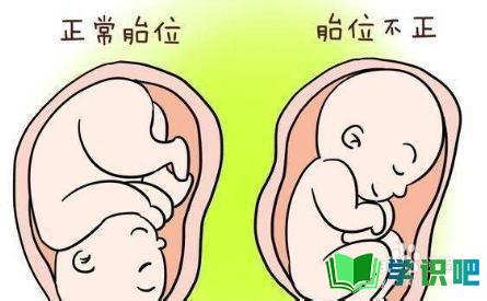 孕后期胎位不正脐带绕颈怎么办？ 第6张