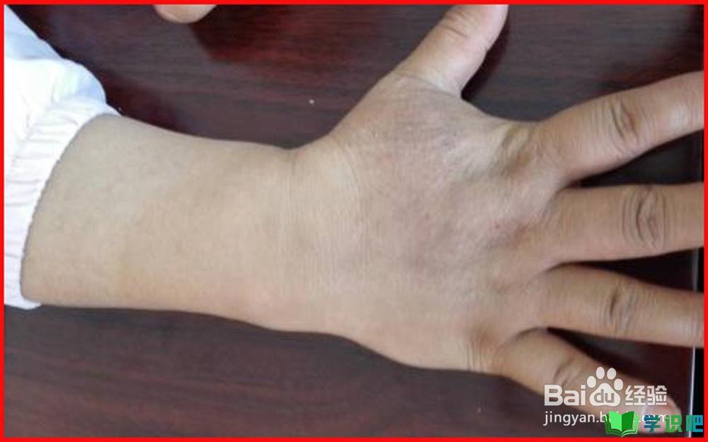 手经常出湿疹怎么办？