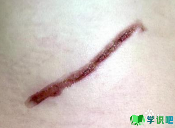 手术后的疤痕怎么办？