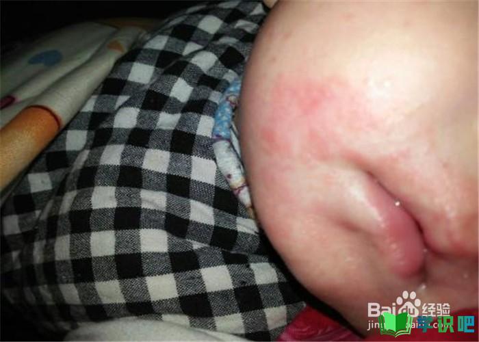 孩子6岁了湿疹还很严重怎么办？