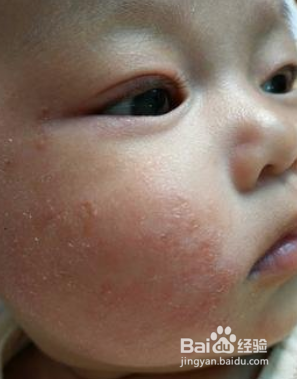 婴儿湿疹怎么办？
