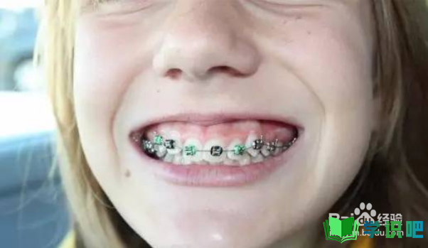 儿童牙齿矫正托槽老掉怎么办？