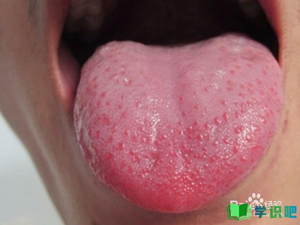 得了舌炎怎么办？ 第7张