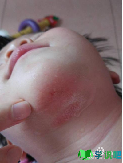 婴儿脸上湿疹怎么办？ 第7张