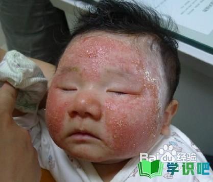 婴儿长湿疹怎么办？ 第3张